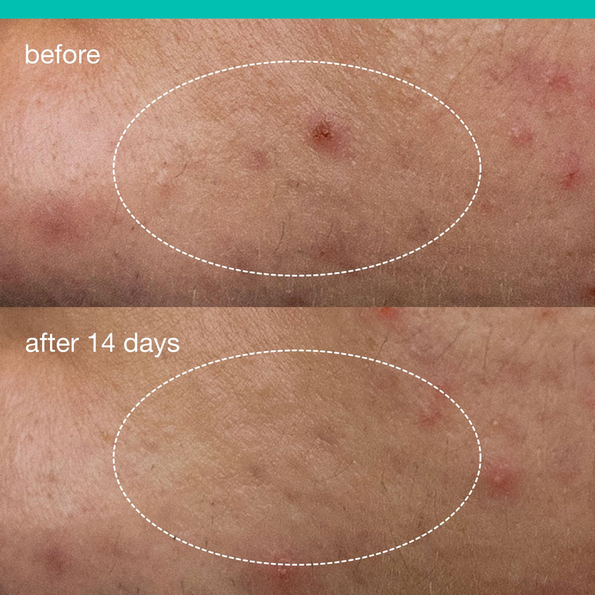 Dermalogica application on cheek demonstrating targeted spot coverage benefit