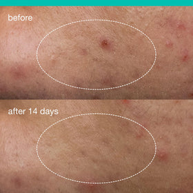 Dermalogica application on cheek demonstrating targeted spot coverage benefit