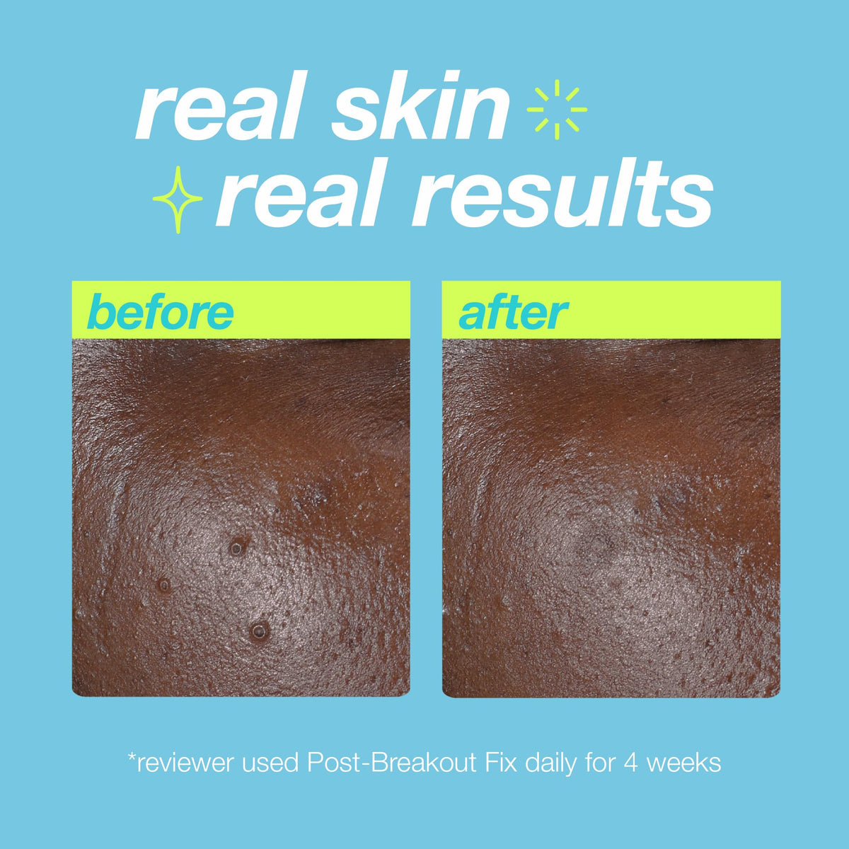 Dermalogica applying a small dab to a spot demonstrating targeted use