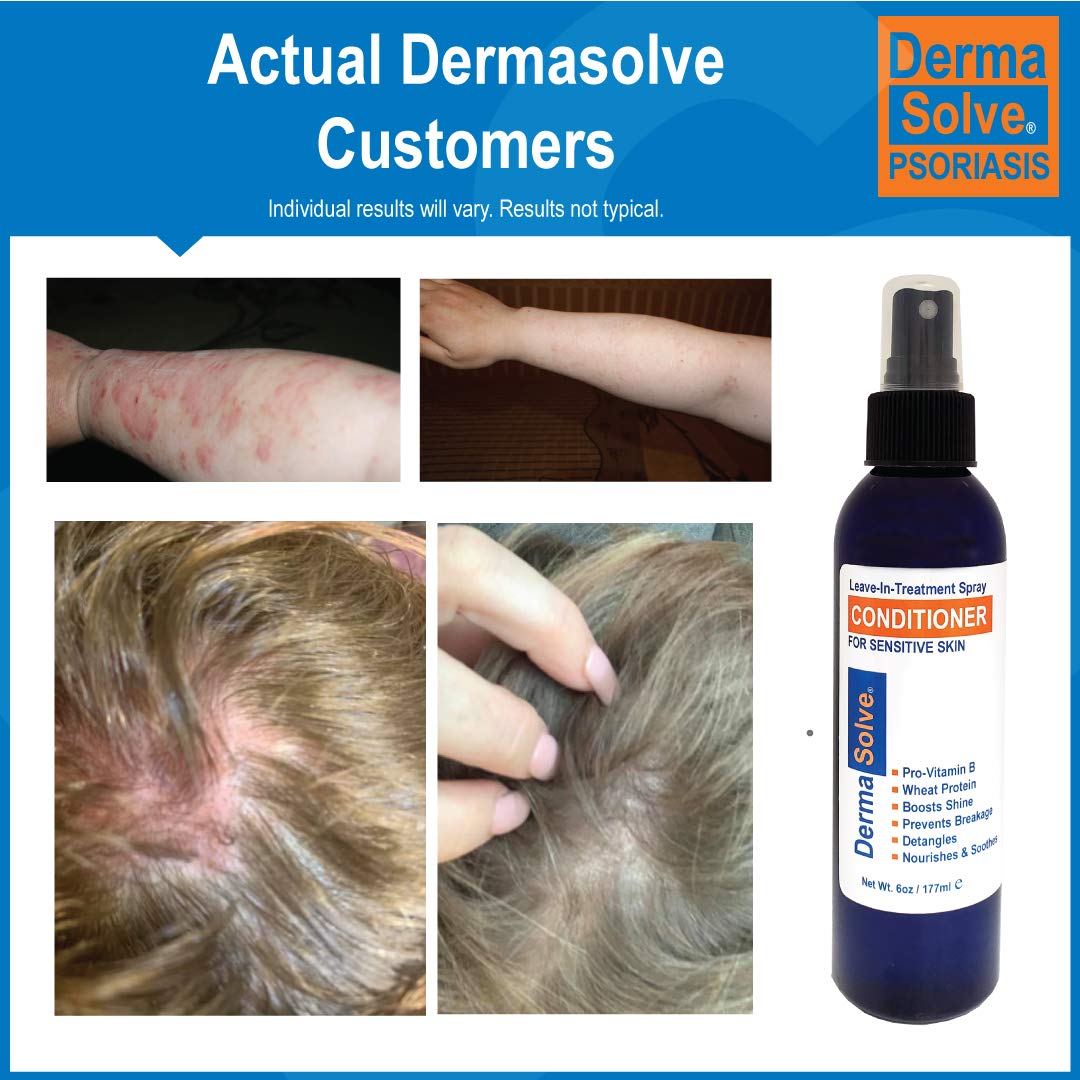 Dermasolve used while combing to detangle and prevent breakage