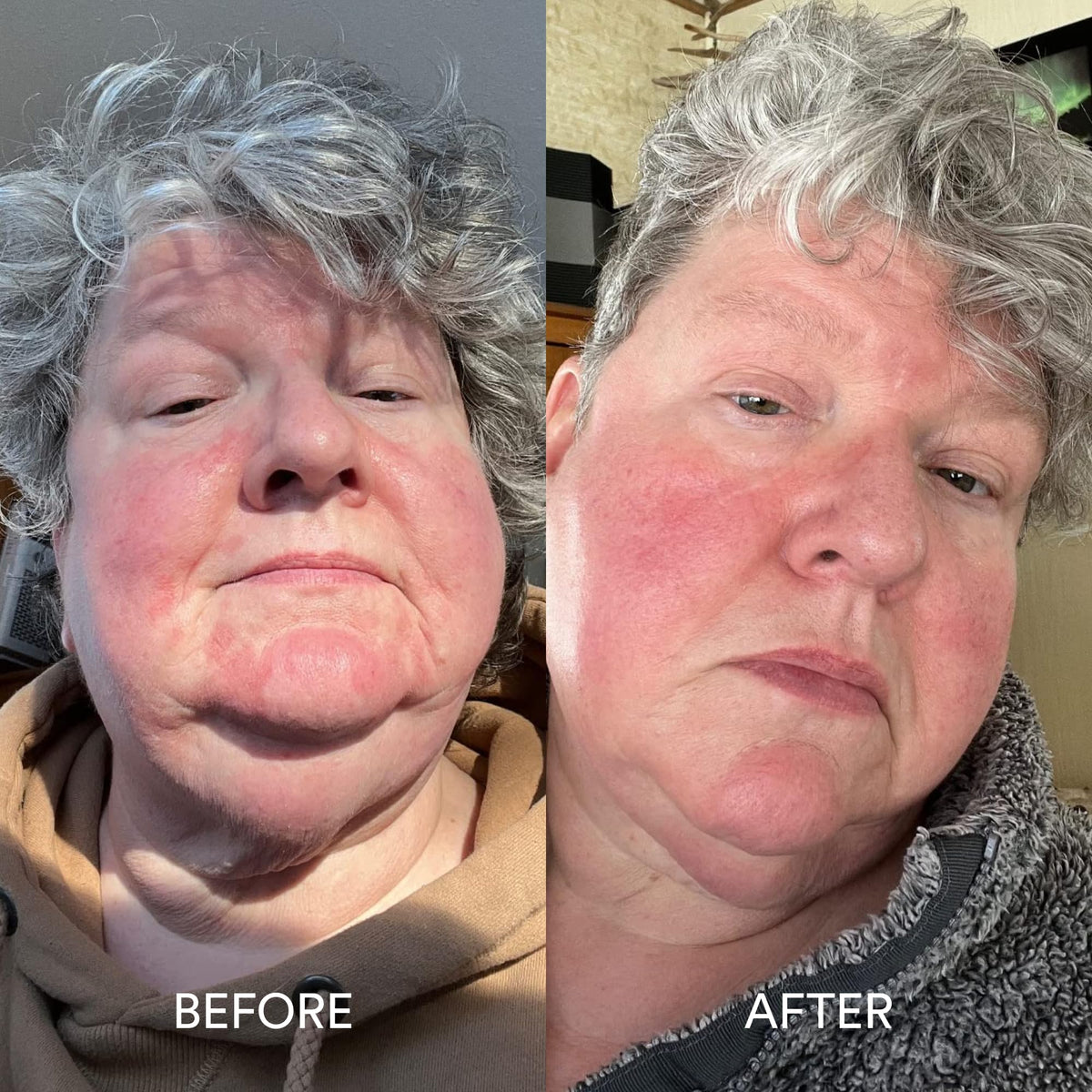 Dermazen paired with calming serum to amplify soothing results