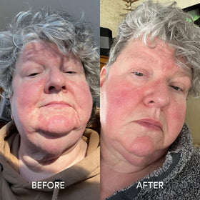 Dermazen paired with calming serum to amplify soothing results