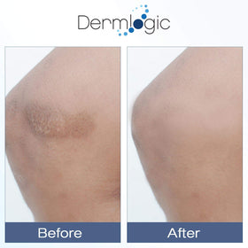 Dermlogic under-eye application showing gentle patting to reduce puffiness
