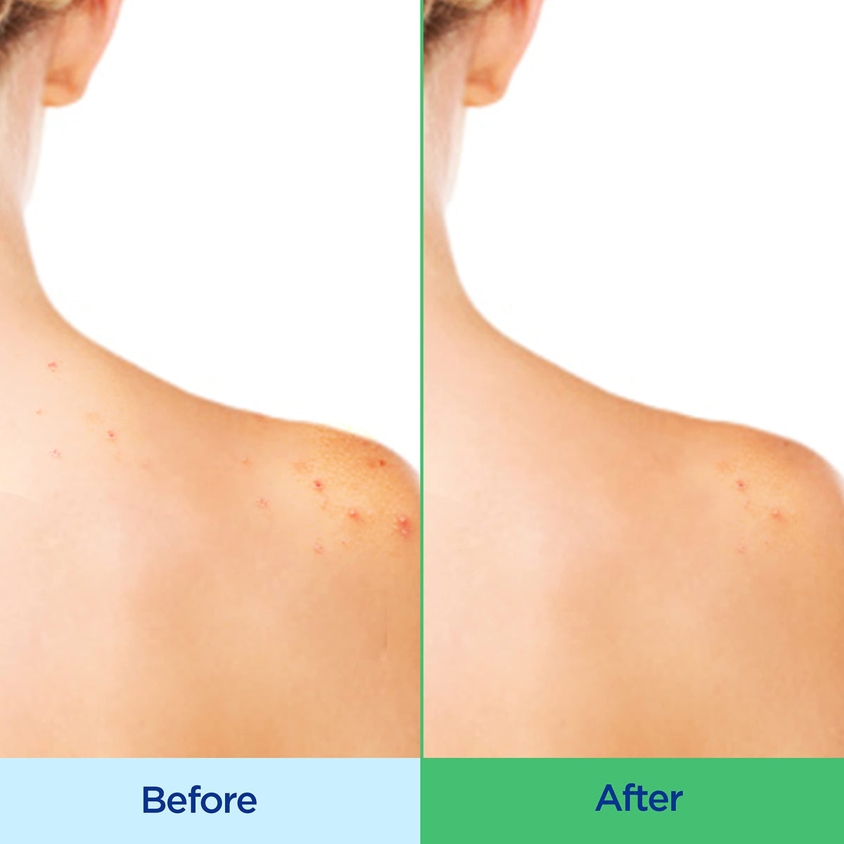 Differin being dispensed into hand, shows easy application and effective lather