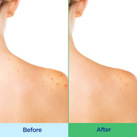 Differin being dispensed into hand, shows easy application and effective lather