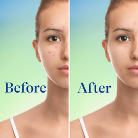 Differin label close-up showing 10% benzoyl peroxide strength clearly