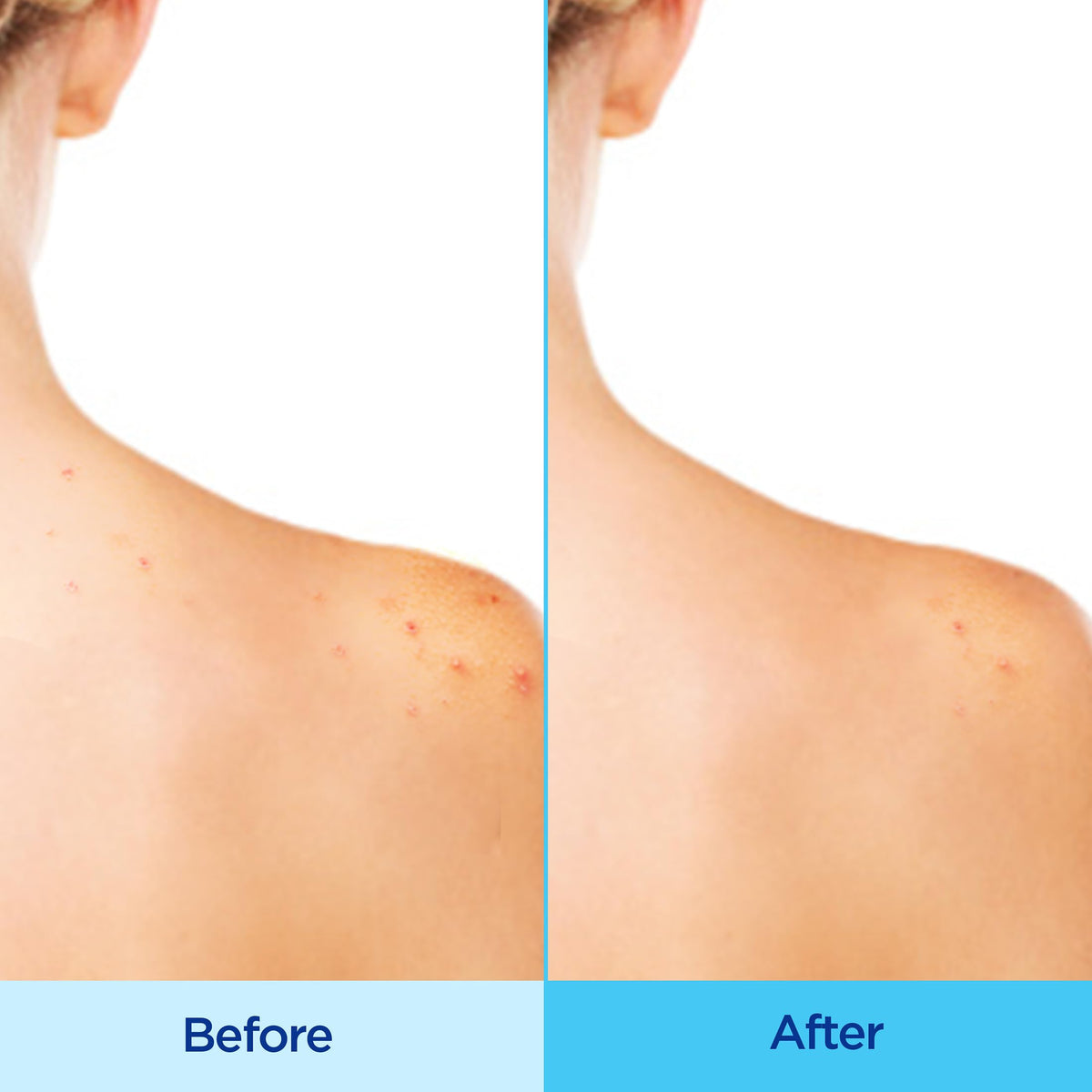 Differin mist spraying on back, reaches hard-to-access blemishes