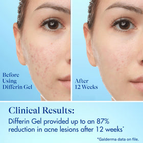 Differin products on bathroom counter at night showing routine-ready benefit