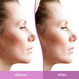 Differin side label showing ingredients and dermatologist-tested benefit