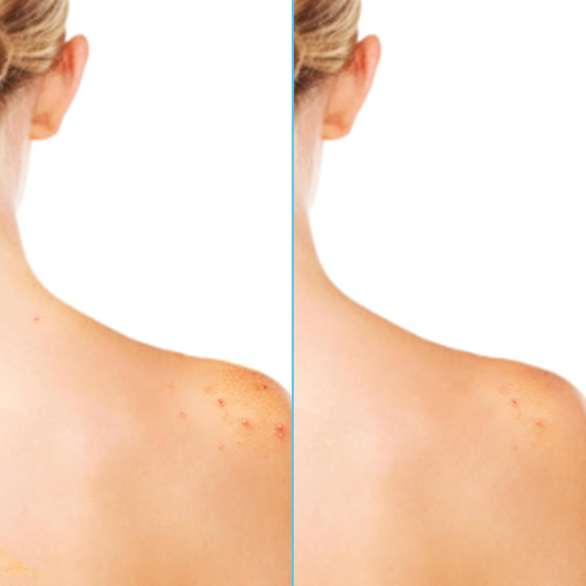 Differin fine mist on skin texture, lightweight hydration and exfoliation