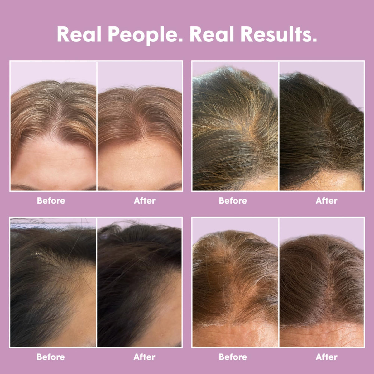 dpHUE before and after root coverage showing discreet concealment