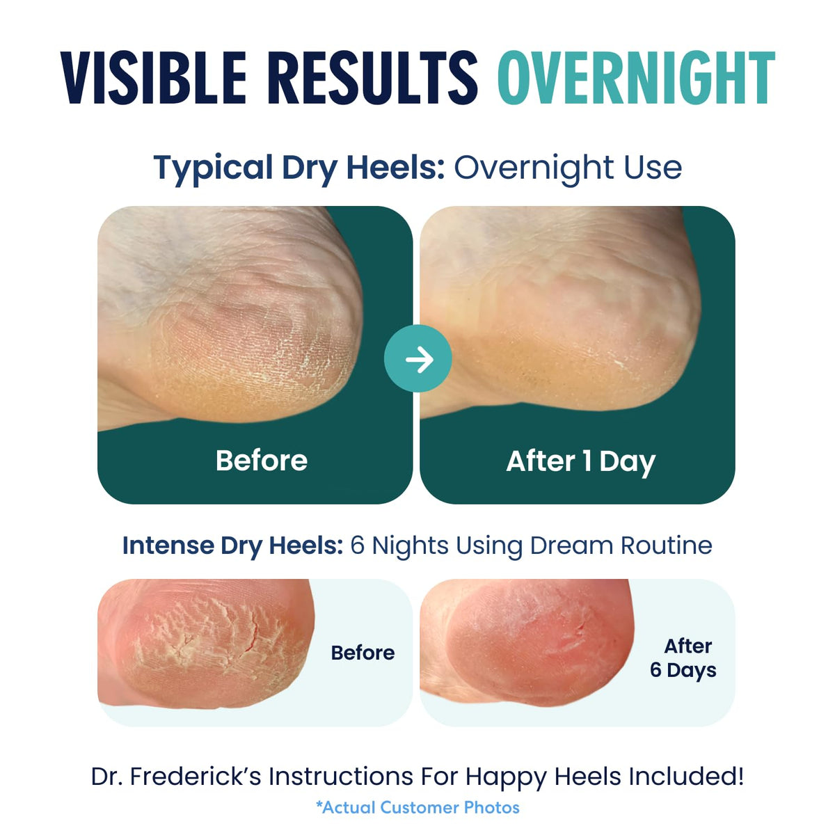 Dr. Frederick's socks worn at bedtime, demonstrates effortless overnight heel hydration