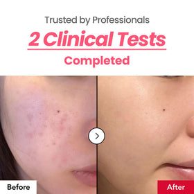 dr.percent applying cream to cheek to show spot coverage and gentle finish