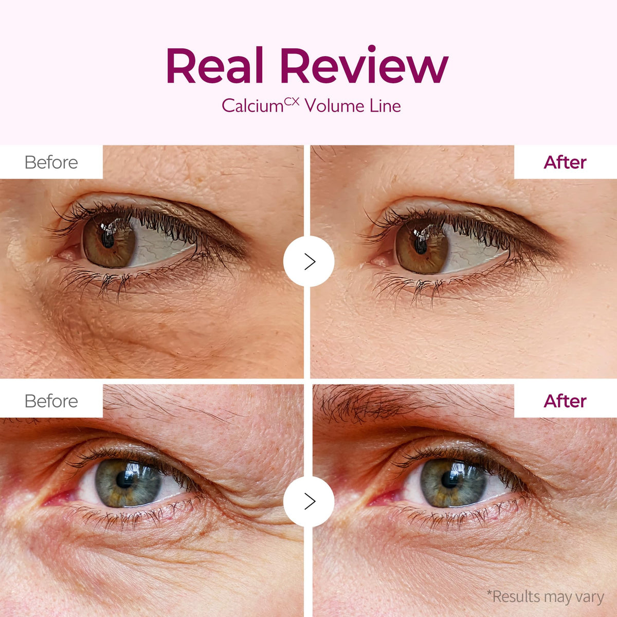 Dr.Melaxin patch applied under eye showing immediate de-puffing benefit