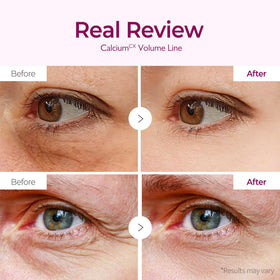Dr.Melaxin patch applied under eye showing immediate de-puffing benefit