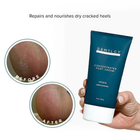 DRMTLGY cream applied to heel showing targeted use and visible softening benefit