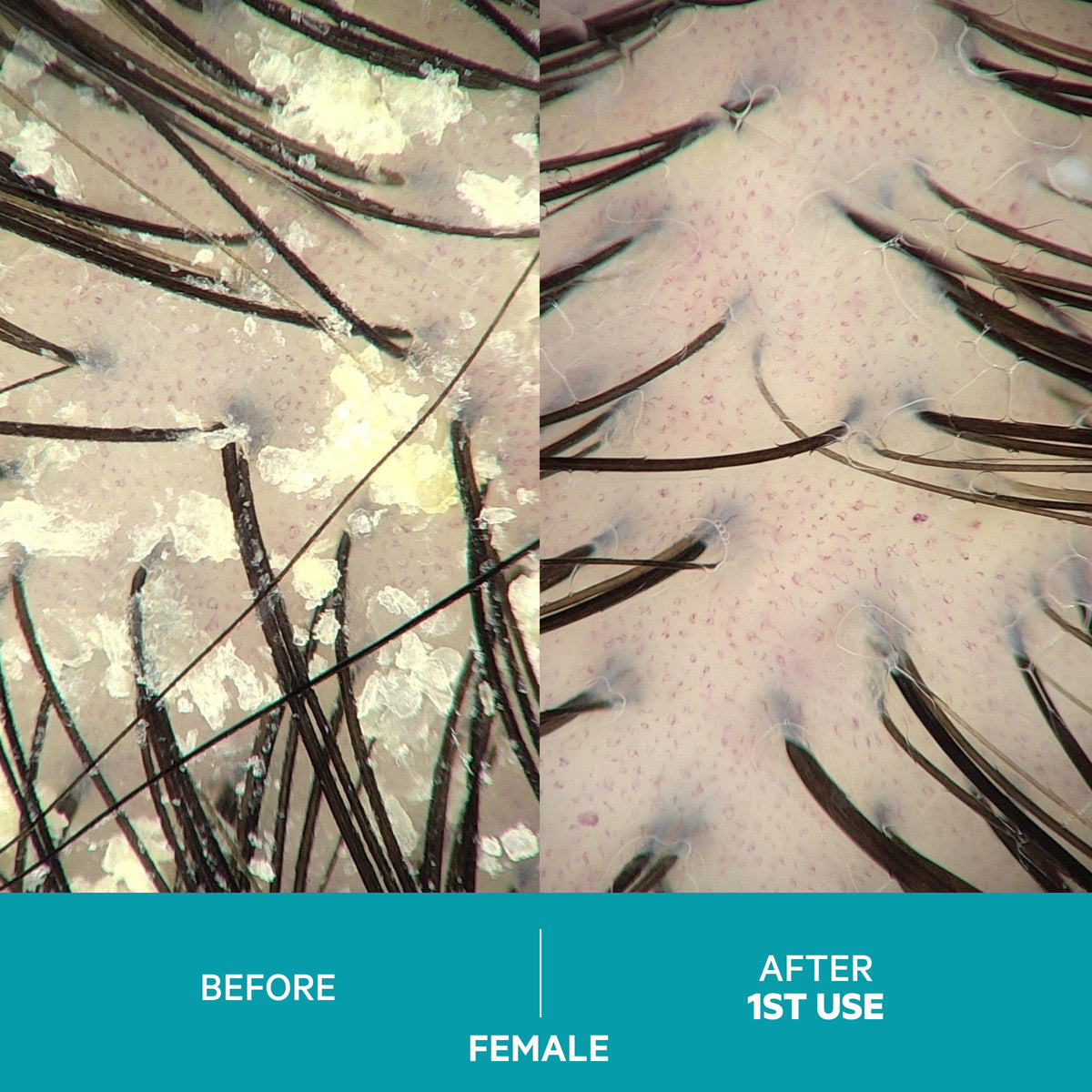 DS Laboratories before and after scalp strip demonstrating fewer flakes