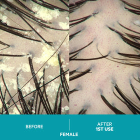 DS Laboratories before and after scalp strip demonstrating fewer flakes