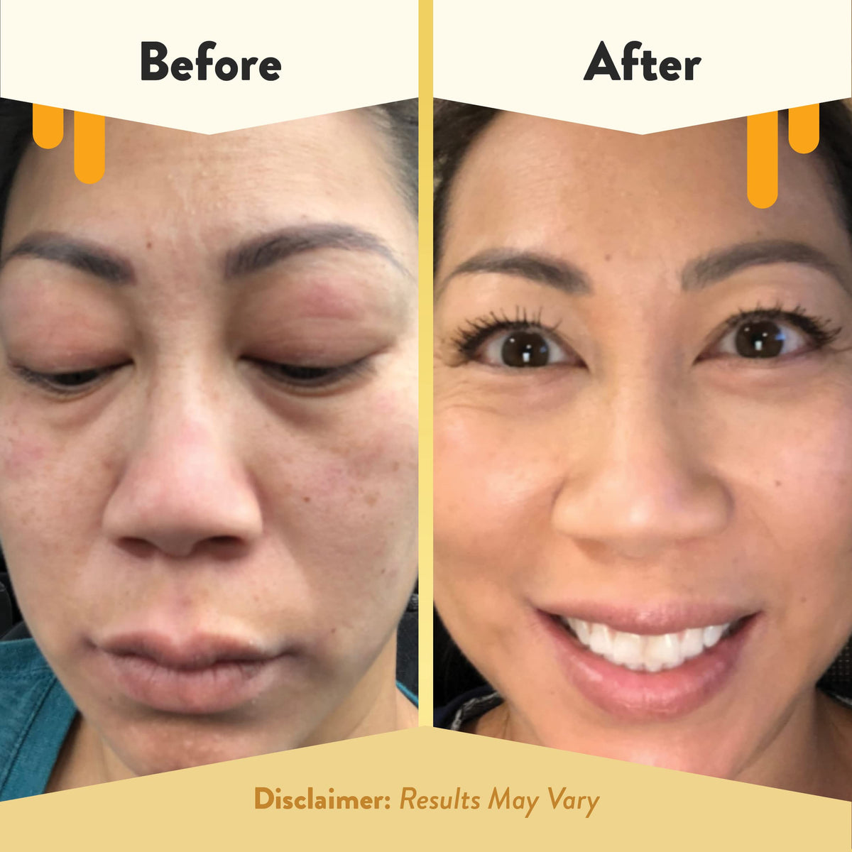 ECZEMA HONEY used on eyelid and lip area highlighting safe gentle care for delicate facial zones