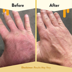 ECZEMA HONEY being used to wash hands demonstrating gentle daily cleansing