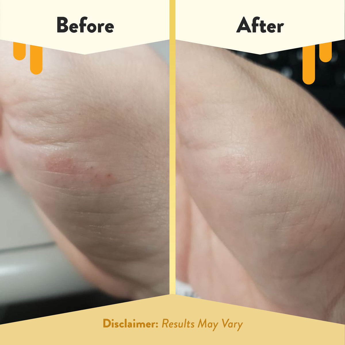 ECZEMA HONEY hand holding a pad to show scale and on-the-go ease