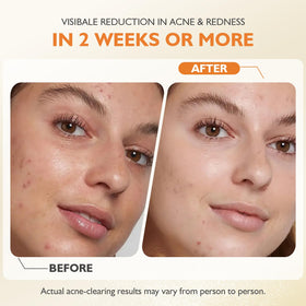 elesysy applied to cheek demonstrating targeted acne control and calming effect