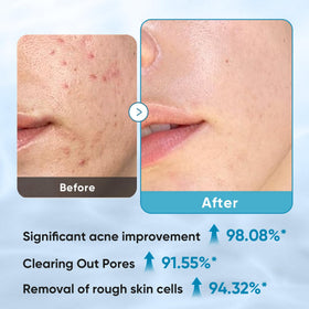 Elvira saturated pad dripping serum to show glycolic and salicylic concentration