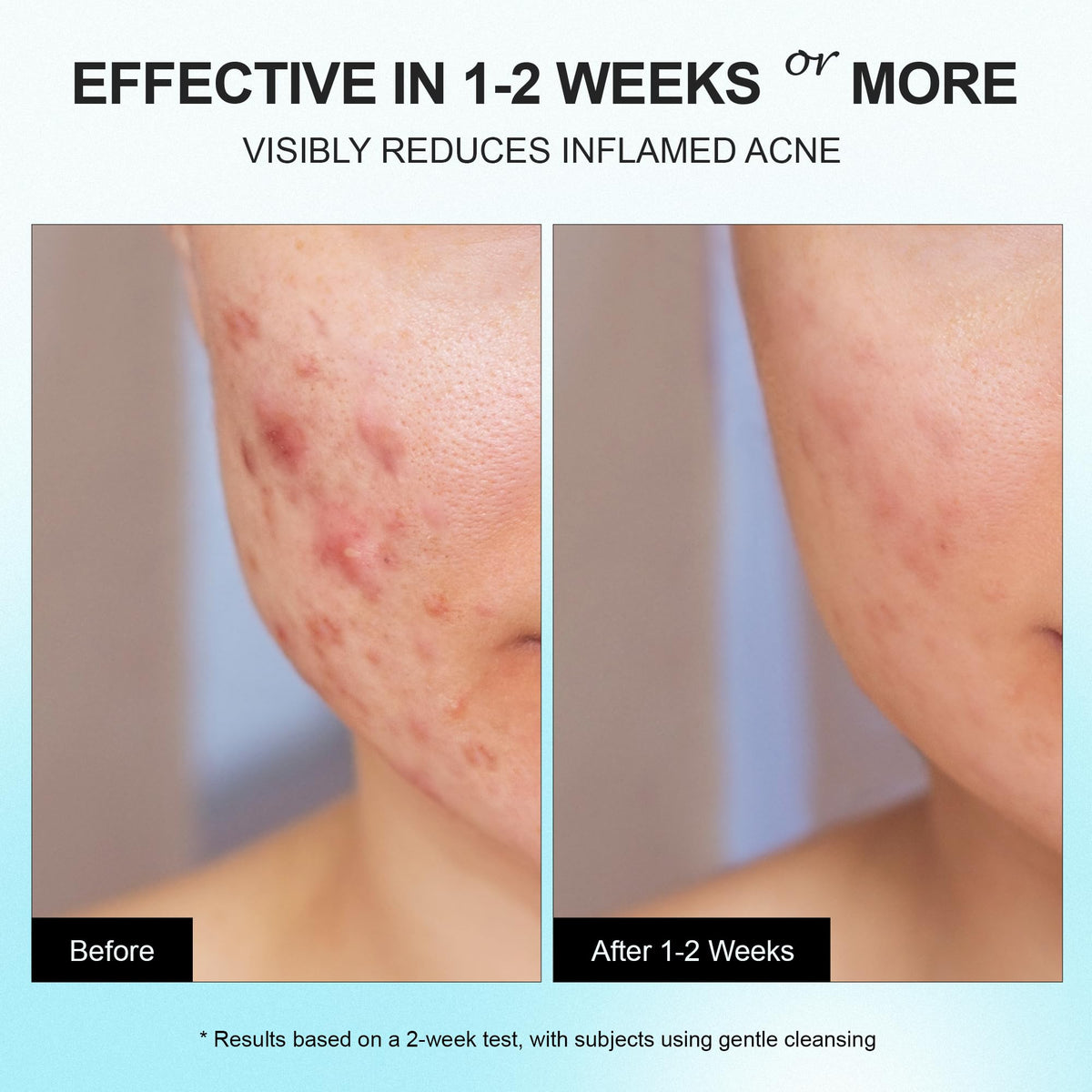 Enaskin Naturals applying cream to cheek for targeted relief