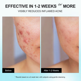 Enaskin Naturals applying cream to cheek for targeted relief