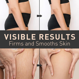 Enaskin Naturals applied to thighs and hips in a lifestyle scene suggesting improved texture and confidence