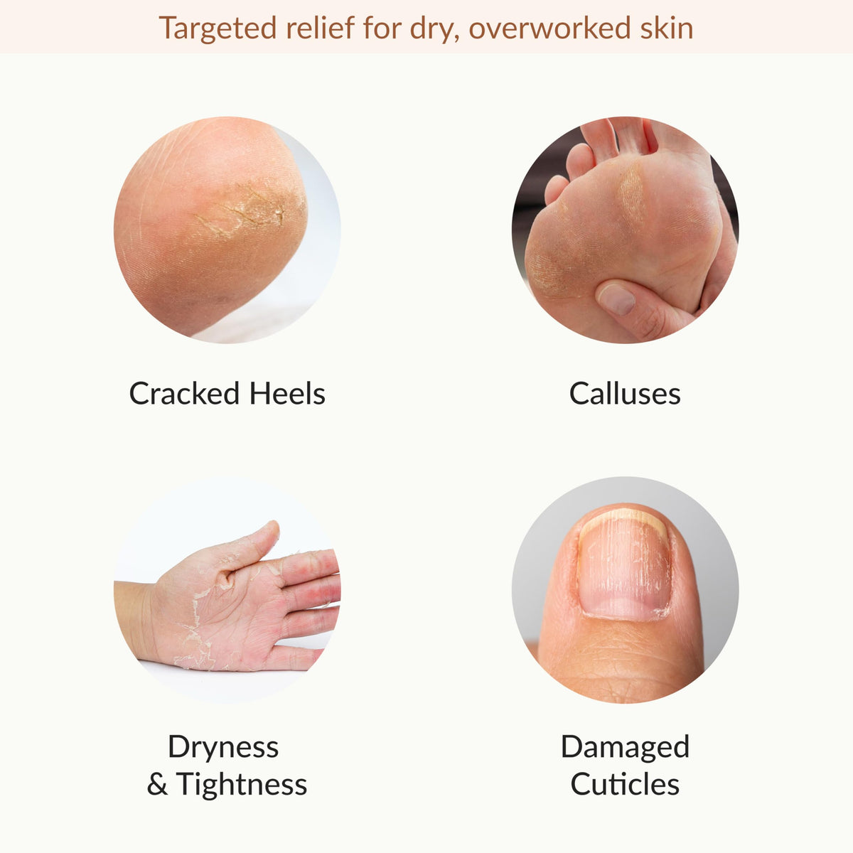 Epielle in use on hands with gloves providing convenience and relief