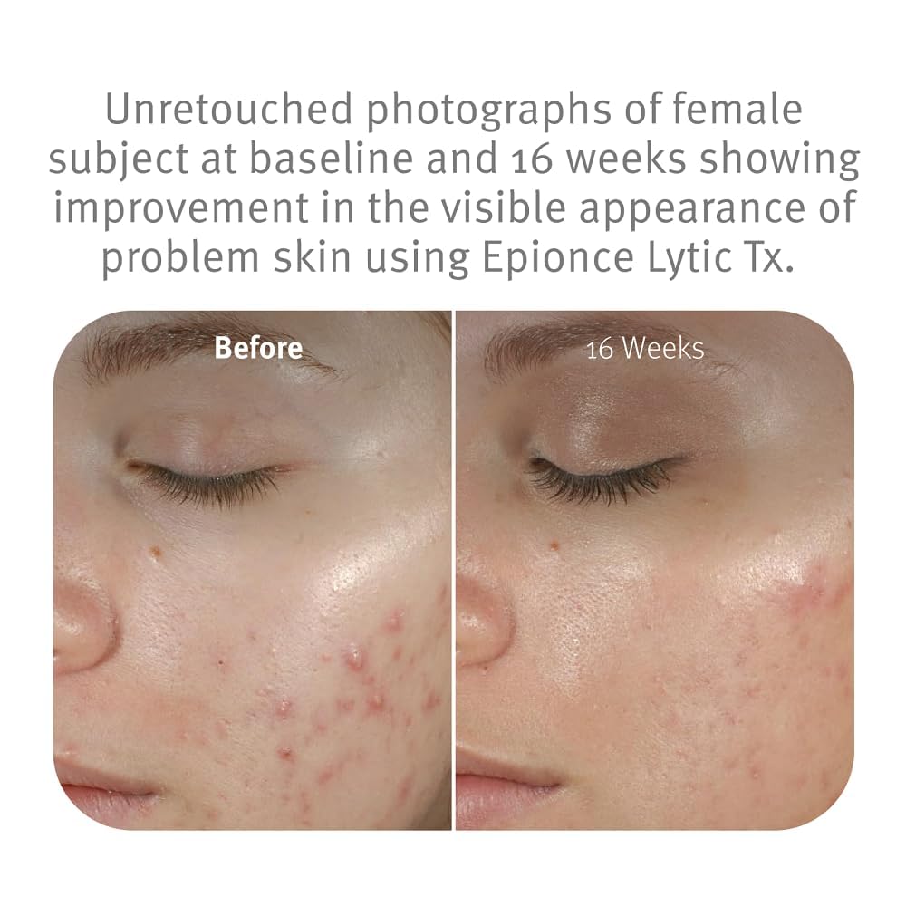 Epionce Lytic Tx texture on fingertip demonstrating lightweight, easily absorbed benefit
