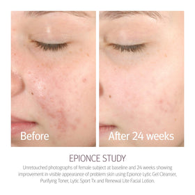 Willow bark and cucumber botanicals highlighting Epionce ingredient clarity and soothing
