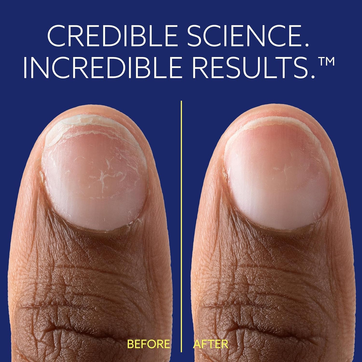epres ePhD application on natural nail illustrating strengthened nail edge after use