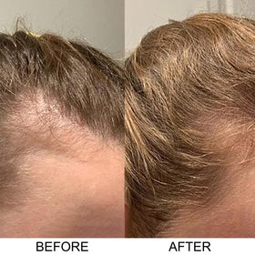 Person applying Excalvo in shower demonstrating scalp massage benefit