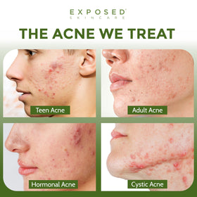 Exposed Skin Care pump dispensing gel demonstrating controlled application