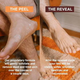 FEETS feet before and after treatment showing softer smoother heels