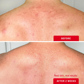 First Aid Beauty being applied to back to show hands-free hard-to-reach treatment