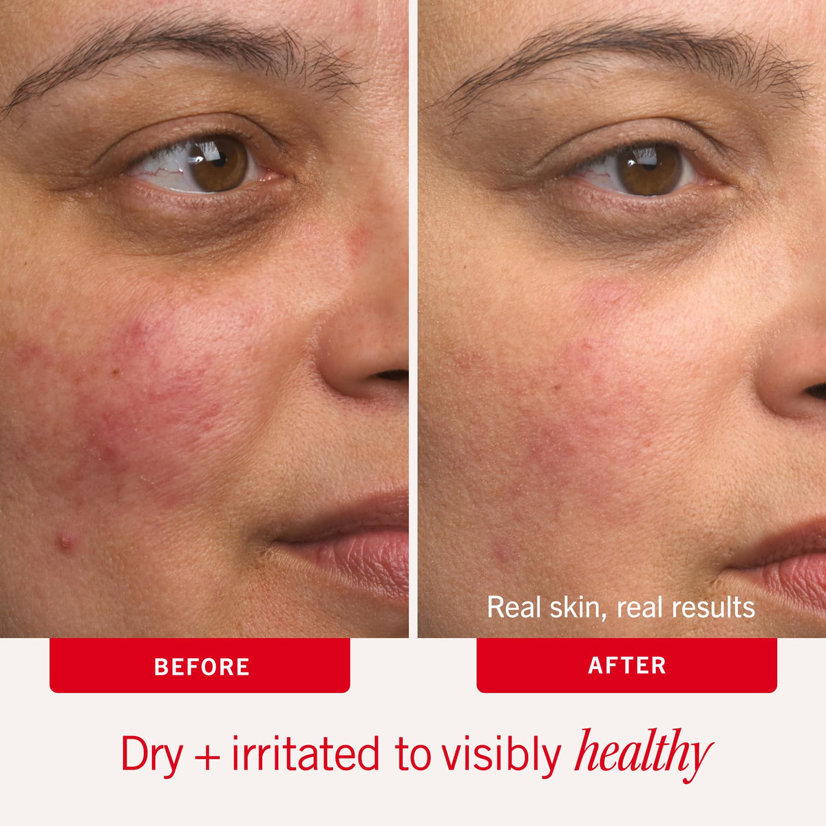 Hand applying First Aid Beauty cream to show quick relief and softness
