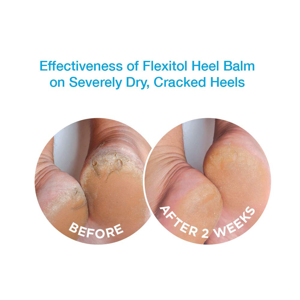 Flexitol being applied to a heel demonstrating targeted moisturization and immediate softening benefit