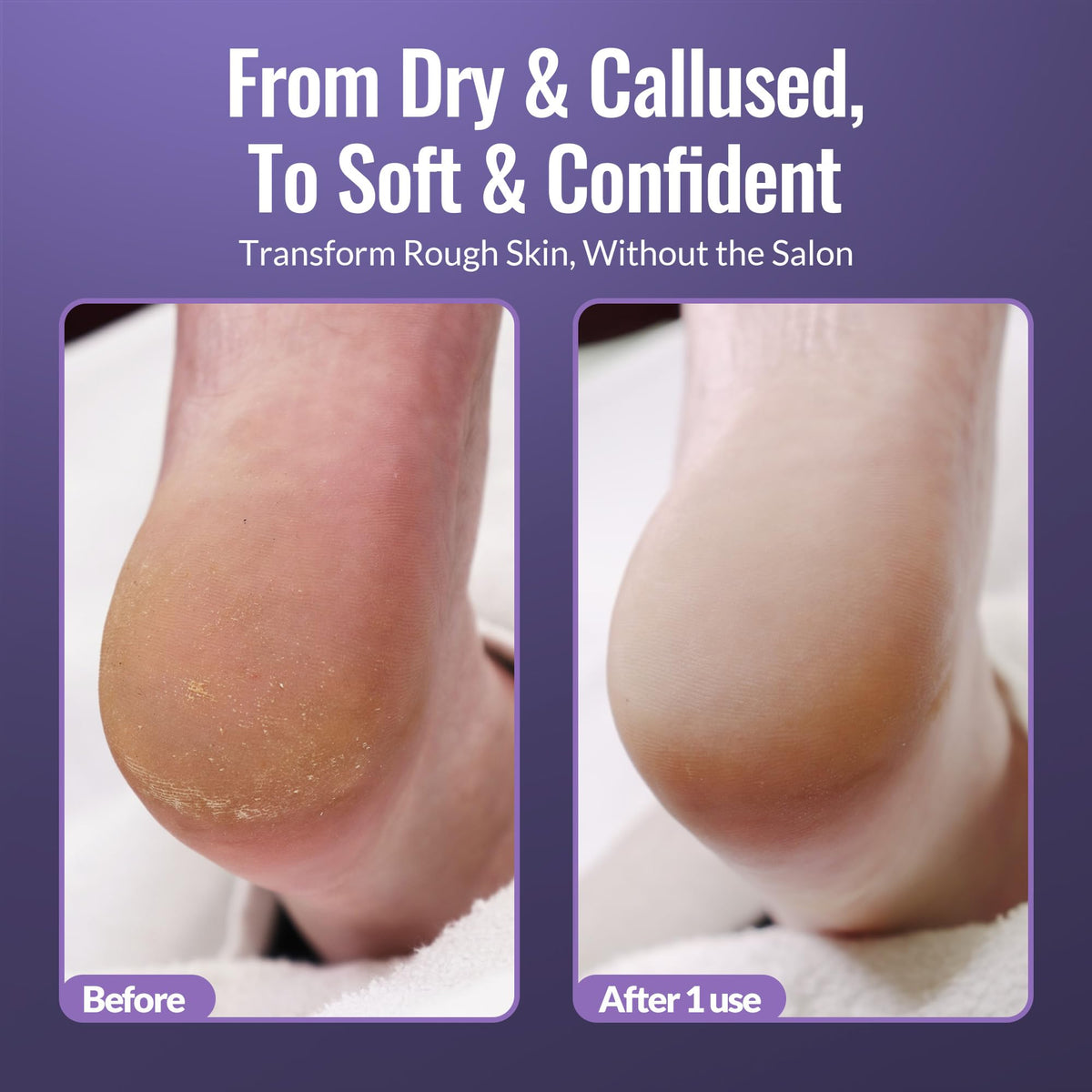 Footlogix spray applied to heel demonstrating targeted softening benefit