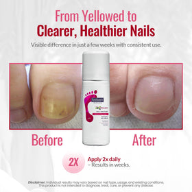 FOOTLOGIX spray being applied to a toenail promoting convenient targeted care
