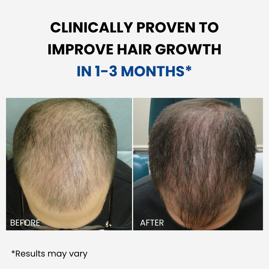 Forchics ForHair nozzle spraying fine mist onto scalp, ensures precise localized application