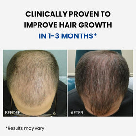 Forchics ForHair nozzle spraying fine mist onto scalp, ensures precise localized application