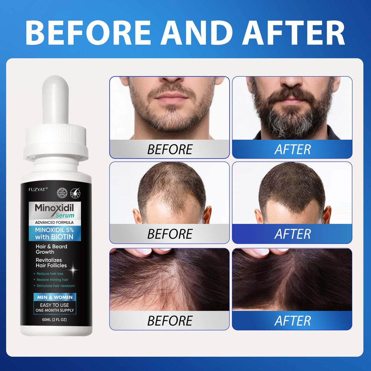 FUZYAT being applied to scalp showing targeted application for improved coverage