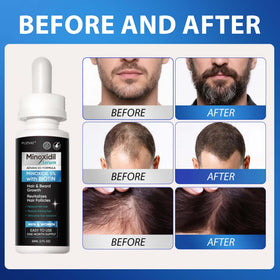 FUZYAT being applied to scalp showing targeted application for improved coverage