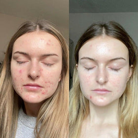 Generic retinol gel on bathroom counter during nighttime routine, supporting evening use
