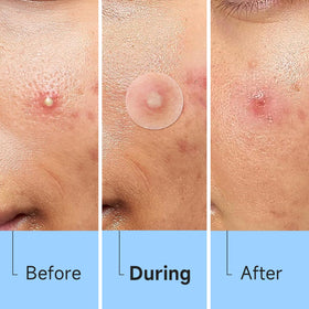 Glowpatch clear patch applied to cheek providing discreet coverage and protection