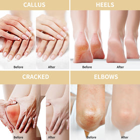 Grocerism cream applied on heel demonstrating callus softening benefit
