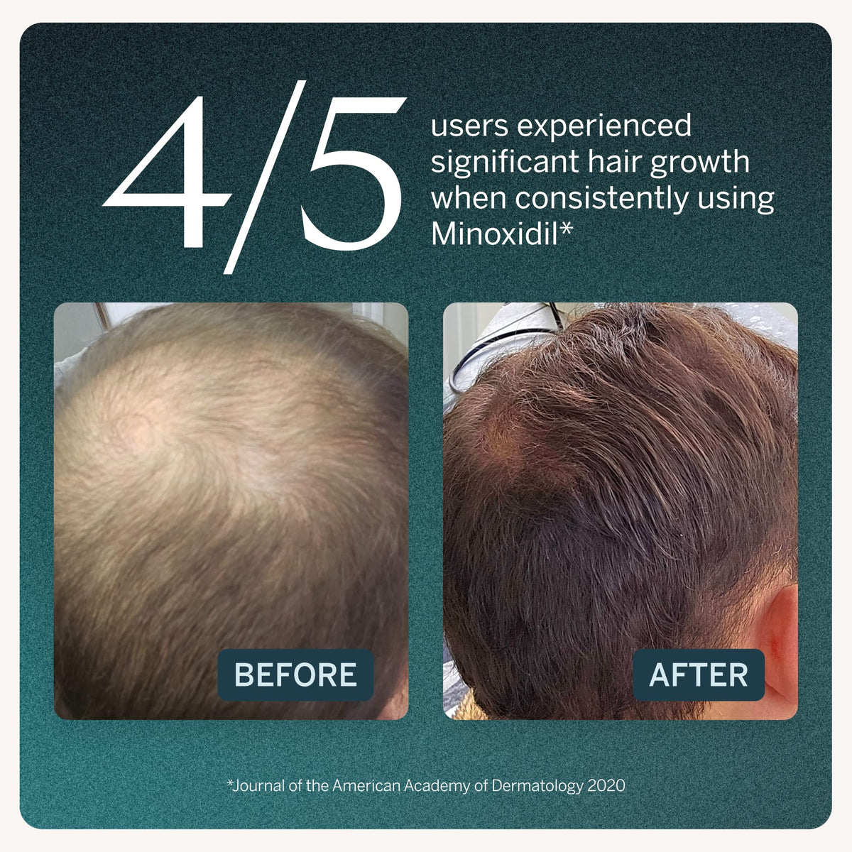 Happy Head close-up of dropper applying solution to scalp for precise, targeted placement